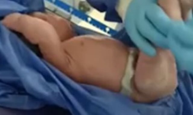 عملية ولادة قيصرية لأم مصابة بفيروس كورونا