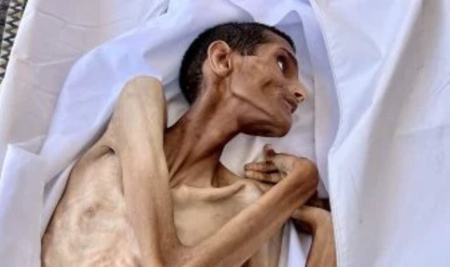 شاب فلسطينى يموت جوعا فى مستشفى الشفاء