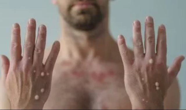 جدرى القرود