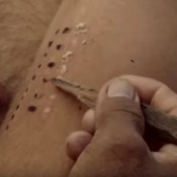 طريقة كامبو للعلاج