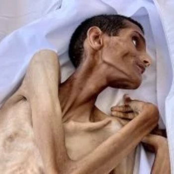 شاب فلسطينى يموت جوعا فى مستشفى الشفاء