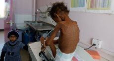طفل مصاب بسوء التغذية